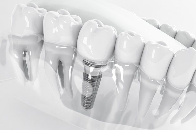 trồng răng implant yenle dental